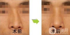 歪鼻矯正一般多少錢？歪鼻矯正手術(shù)價格詳細解析