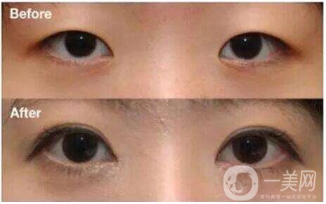 割雙眼皮和開(kāi)眼角*果好嗎 *果圖分享