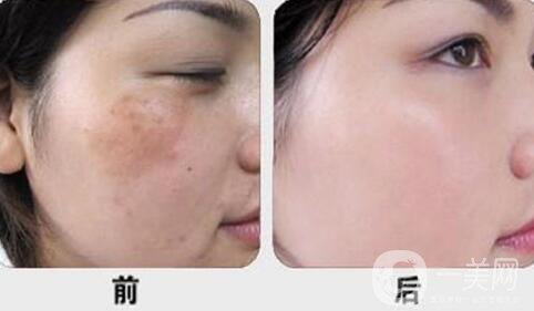激光調(diào)節(jié)黃褐斑要多少錢？激光祛黃褐斑價(jià)格價(jià)格分析