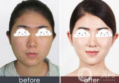 光子嫩膚果怎么樣？光子嫩膚多長時(shí)間做一次？