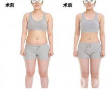 超聲波吸脂減肥果怎么樣？超聲波吸脂減肥多少錢？　　