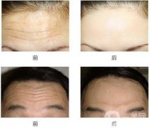 去抬頭紋好的方法？去抬頭紋那種方法好？