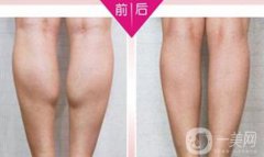 注射瘦腿果好嗎？注射瘦腿多少錢一針？