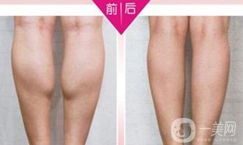 **果好嗎？*多少錢一針？