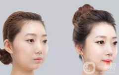 咬肌切除手術(shù)多少錢？切除咬肌價格收費明細~