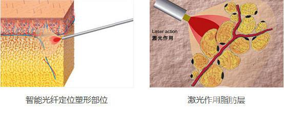 光纖溶脂減肥*果嗎?有哪些注意事項？