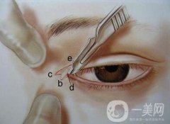 開眼角有風險嗎？開眼角風險有哪些？