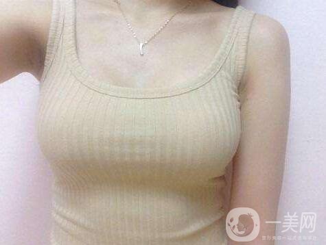 娜高假體隆胸多少錢？收費情況說明~