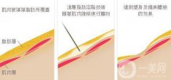溶脂的價格一般是多少？溶脂一般多少錢？