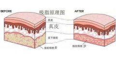 吸脂價格多少？吸脂價格詳細分析