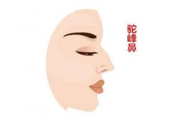 駝峰鼻矯正方法？如何矯正駝峰鼻