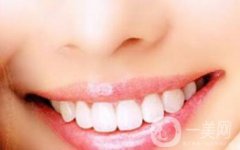 烤瓷牙多久換一次？烤瓷牙如何護理