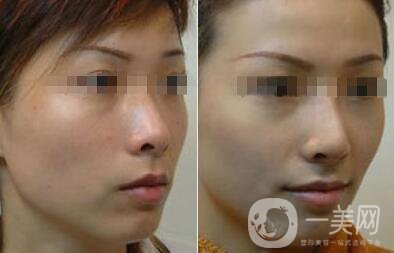 光子嫩膚大概要多少錢？光子嫩膚價(jià)格詳解