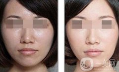 彩光嫩膚要多少錢？彩光嫩膚價(jià)格需要多少？