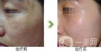 光子嫩膚調(diào)節(jié)黃褐斑*果怎么樣？去黃褐斑圖