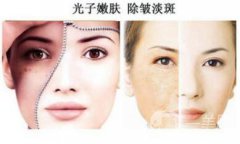 光子嫩膚如何護(hù)理？光子嫩膚的注意事項(xiàng)