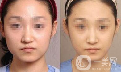 去頰脂墊要多少錢？去頰脂墊價(jià)格詳解