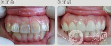 四環(huán)素牙怎么變白？四環(huán)素牙怎么辦？