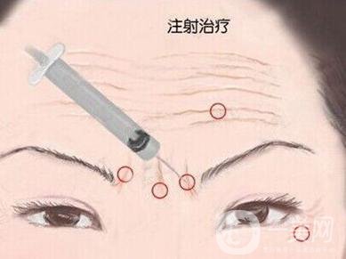 *生物除皺*果好不好？有副作用嗎？