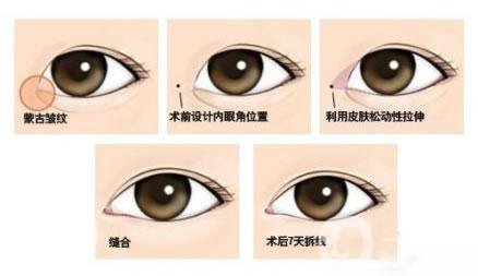 韓式開眼角多少錢？?jī)r(jià)格很貴嗎？