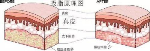 吸脂的價(jià)格一般是多少？價(jià)格差異大嗎？