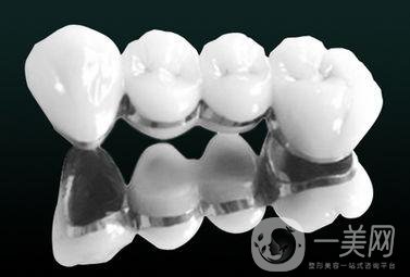 烤瓷牙有哪些種類(lèi)？多久可以恢復(fù)？