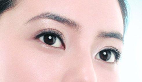 焊接雙眼皮是什么？手術(shù)后多久能好？