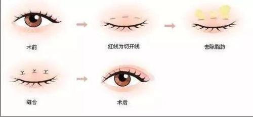 焊接雙眼皮是什么？手術后多久能好？
