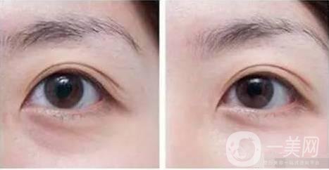 自體脂肪填充眼眶注意事項(xiàng)主要有哪些？