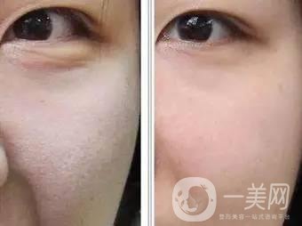果酸換膚后注意事項(xiàng)盤點(diǎn)大揭秘，該怎么做？