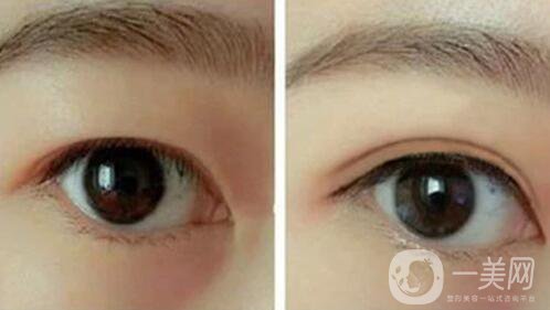 韓式三點雙眼皮是埋線還是割？手術(shù)*果怎么樣