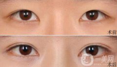 高分子埋線是*的嗎？可以維持幾年？