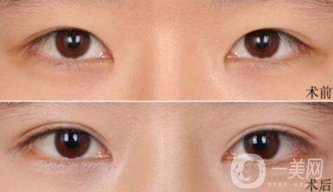 高分子埋線是*的嗎？可以維持幾年？