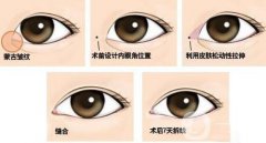 開(kāi)眼角果有哪些、開(kāi)眼角手術(shù)的果怎么樣？