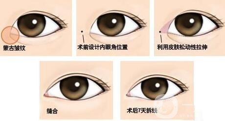 開眼角*果有哪些、開眼角手術的*果怎么樣？