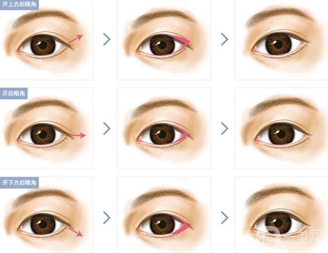 開眼角*果有哪些、開眼角手術的*果怎么樣？