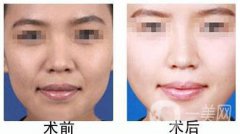 自體脂肪豐鼻唇溝有什么優(yōu)勢(shì)？果怎么樣呢？
