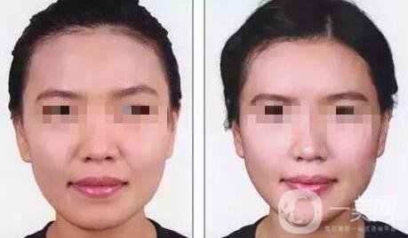自體脂肪豐鼻唇溝有什么優(yōu)勢？*果怎么樣呢？
