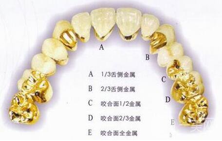 黃金烤瓷牙多少錢一顆？黃金烤瓷牙價格詳解