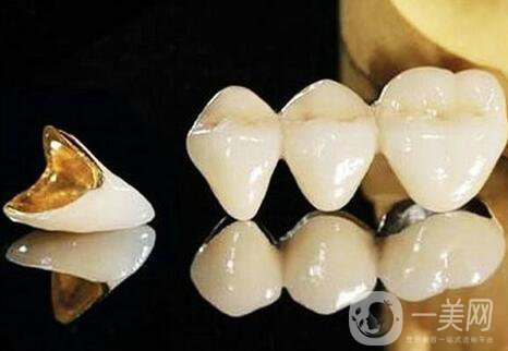 黃金烤瓷牙多少錢一顆？黃金烤瓷牙價格詳解