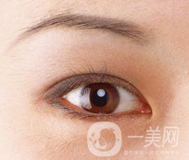 生物焊接雙眼皮是什么？有什么特點(diǎn)？
