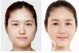 生物焊接雙眼皮是什么？有什么特點(diǎn)？