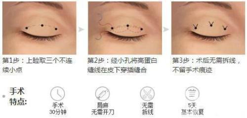 三點(diǎn)式雙眼皮*果一般能撐幾年？
