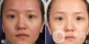 光子嫩膚能去痘印嗎、光子嫩膚去痘印*果怎么樣？