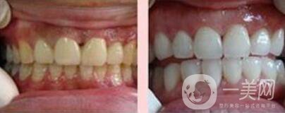 四環(huán)素牙如何變白、四環(huán)素牙怎么調(diào)節(jié)？