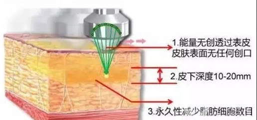 做超聲波吸脂手術(shù)的時候疼嗎？