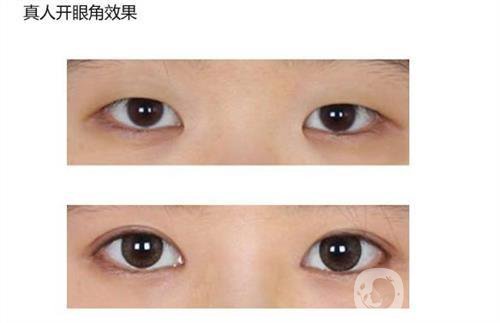 做開(kāi)眼角手術(shù)需要多少錢(qián)？