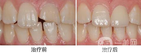 裝個(gè)烤瓷牙多少錢？烤瓷牙詳細(xì)價(jià)格介紹