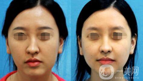 歪鼻矯正需要多少錢？上海歪鼻矯正價(jià)格詳解