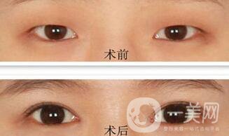 韓式開眼角哪*果好？哪個(gè)醫(yī)院做韓式開眼角比較好